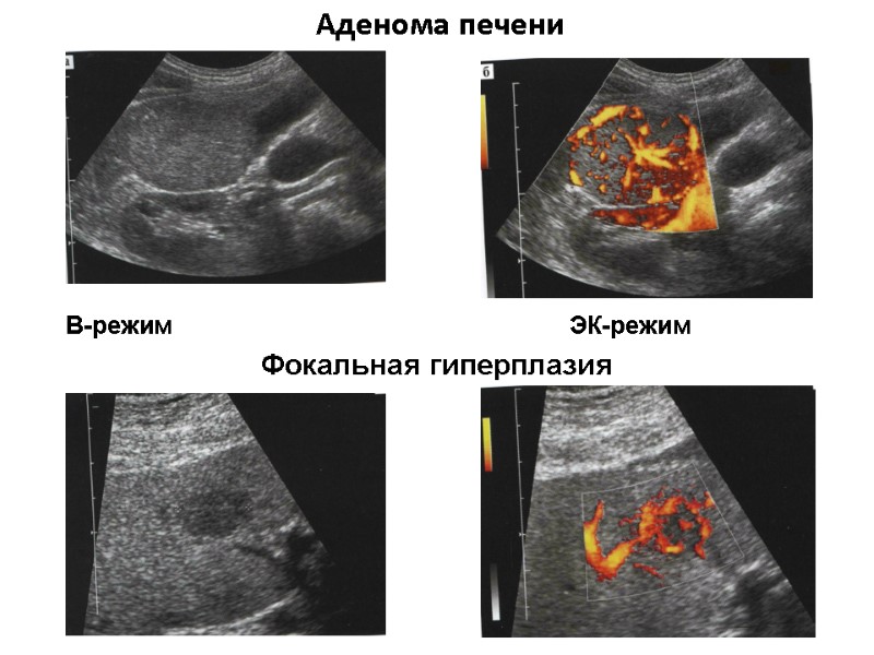 Аденома печени      Фокальная гиперплазия В-режим    